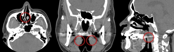 그림  코골이 환자들의 CT영상 =왼쪽부터, 비중격 만곡증, 편도 비대, 늘어진 목젖 소견