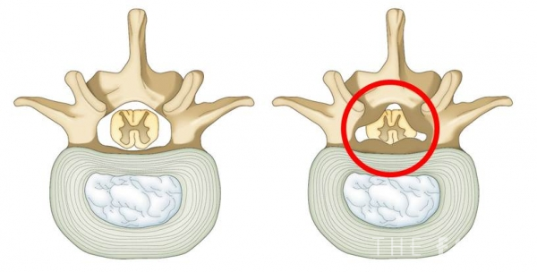 정상적인 척추관(왼쪽)과 협착된 척추관(오른쪽). 빨간 원을 보면 척추관이 좁아진 것을 볼 수 있다. (사진=자생한방병원 제공)