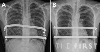 분리고정(A)과 사각고정(B)을 실시한 오목가슴 환자의 흉부 엑스레이. (사진=인천성모병원)