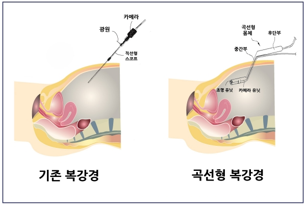 국제성모병원 김보욱 교수, 곡선형 복강 내시경 특허 등록