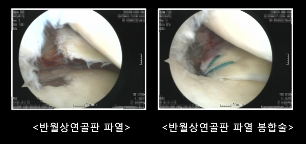 연세사랑병원 “겨울철 스키·보드 즐기다 무릎 ‘뚝’… 반월상연골판 파열 주의”