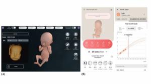 분당서울대병원 산부인과 박지윤 교수 연구팀, '가상현실 3D 태아영상이 산모 애착에 미치는 영향에 대한 무작위배정 임상시험' 연구 발표