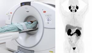 이대서울병원, 전립선암 PSMA PET/CT 검사 도입